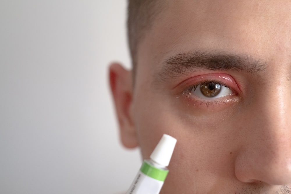 درمان گل‌مژه و عفونت‌های پلک با پماد تتراسایکلین