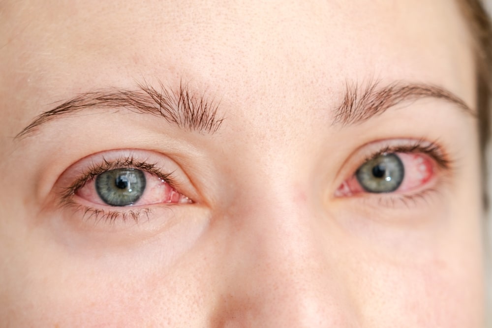 انواع عفونتهای چشمی